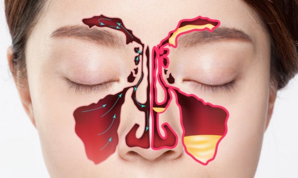 부비강염 항생제