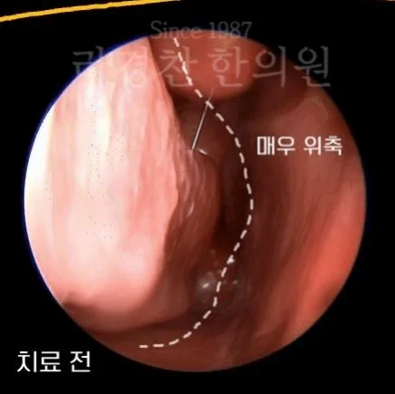 목에 가래 낀 느낌|김경찬 한의원 위축성 비염 치료 전 내시경 사진