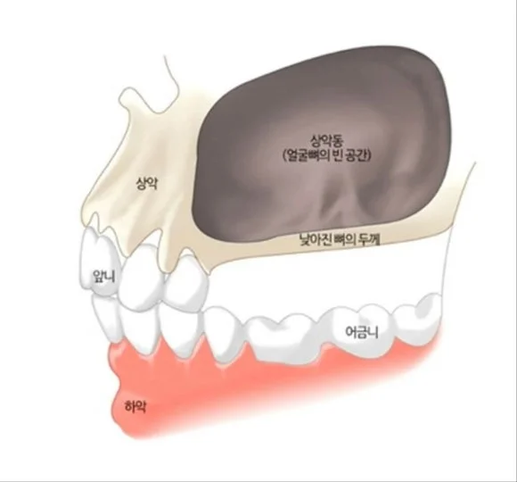부비동염 치통|상악동과 잇몸뼈 구조 및 두께를 나타낸 치과 일러스트