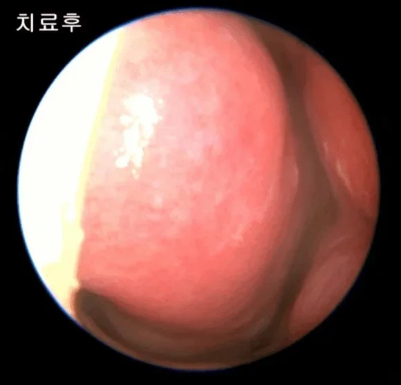 비염 스프레이 부작용|치료 후 비강 내시경 촬영 사진