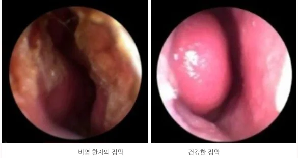 후비루 기침, 왜 가래약을 먹어도 낫지 않을까요?
