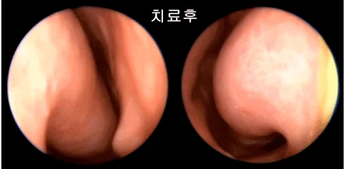 기침이 낫지 않는 이유, 후비루와 비염을 의심해야 합니다