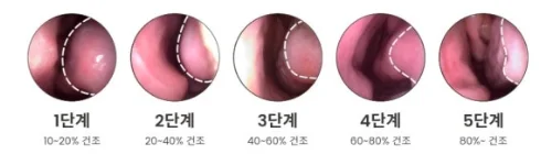 매핵기 후비루, 목에 걸린 듯한 답답함의 정체