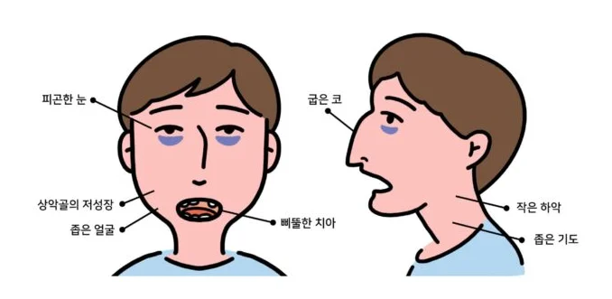 비염 코 뚫는법, 즉시 뚫는 것보다 중요한 한 가지