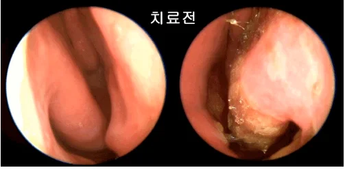 아이 연두색 콧물|이비인후과 비강 내시경 치료 전 상태 사진