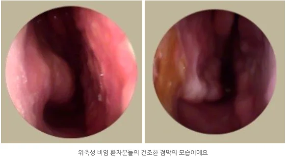 비염치료 잘하는곳|위축성 비염 환자의 건조한 비강 점막 내시경 사진