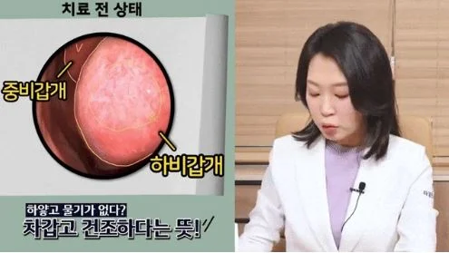 비염 코막힘 뚫는법|치료 전 비강 내 비갑개 상태와 건조함 설명