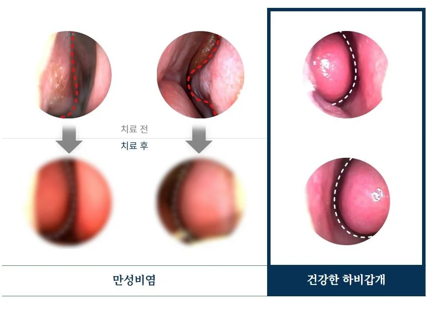 목 이물감이 낫지 않는 이유|만성비염 치료 전후 및 건강한 하비갑개 비교 내시경 사진