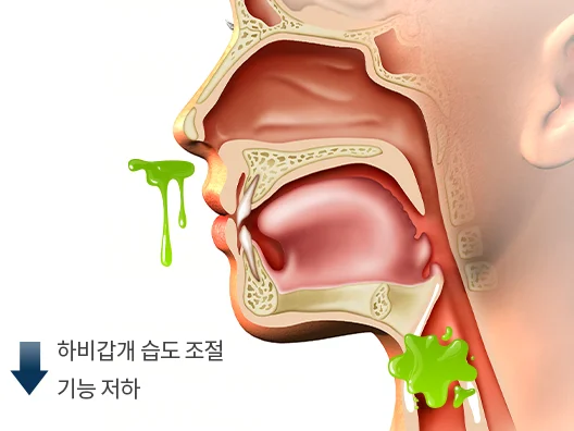 가래삭히는약|하비갑개 습도 조절 기능 저하를 설명하는 의료 일러스트