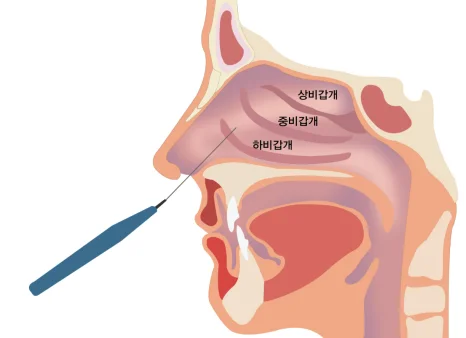 알레르기성 비염 식단|상비갑개, 중비갑개, 하비갑개 구조 코 해부도