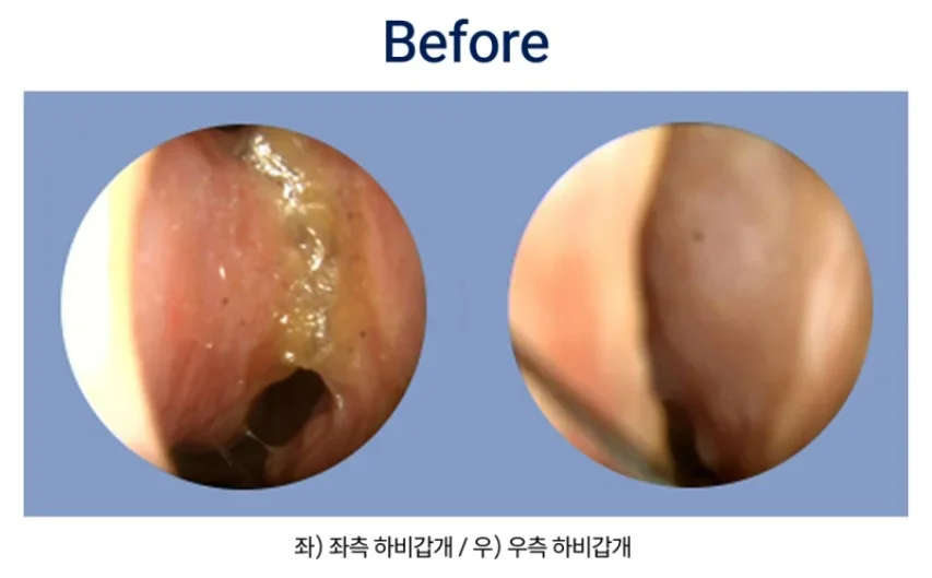 위축성 비염|치료 전 좌우 하비갑개 상태 내시경 사진