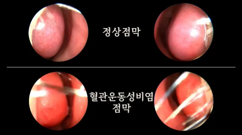 비염 코골이, 숙면 방해하는 코 점막 문제를 해결하세요